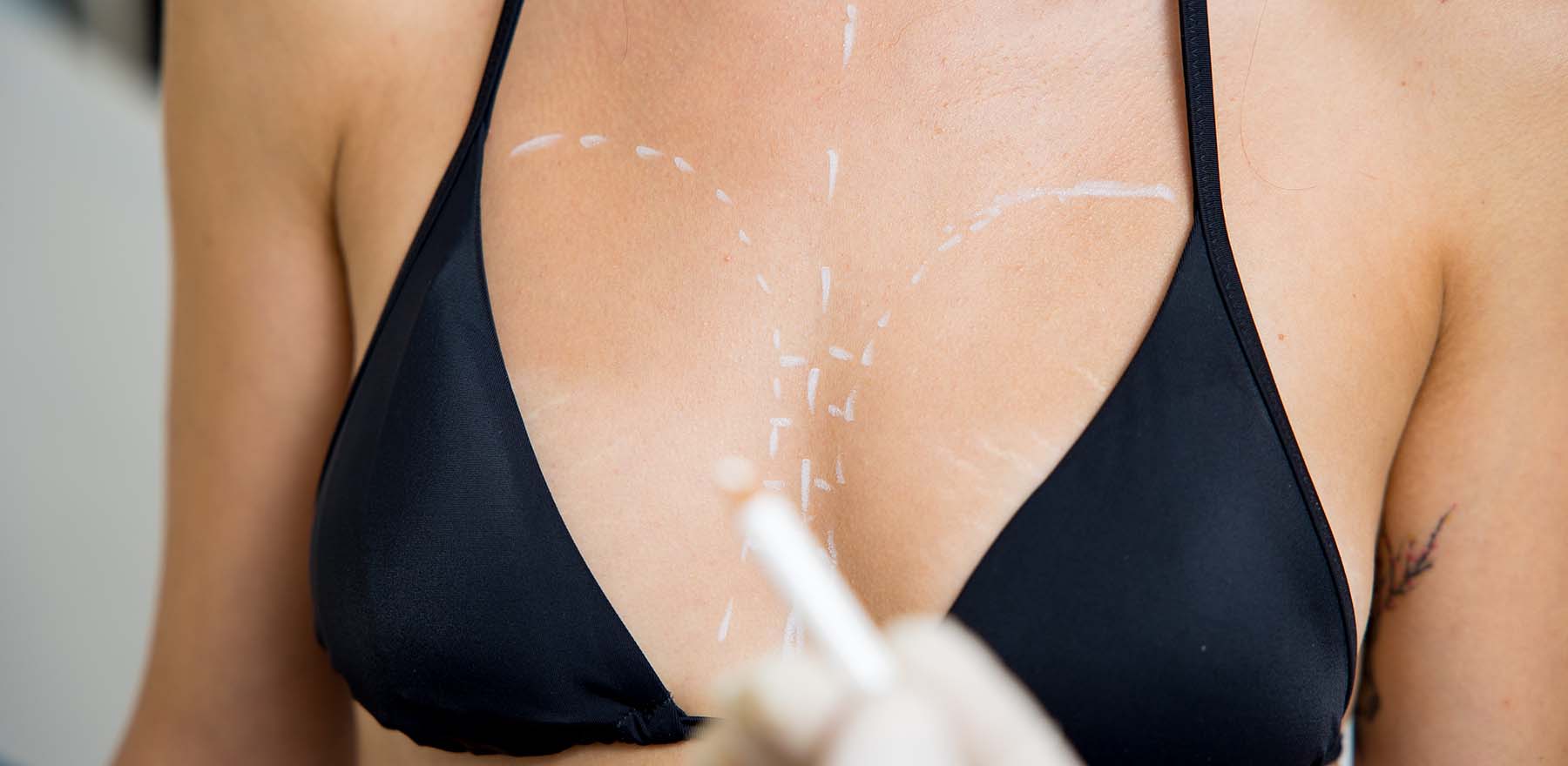 Preparazione all'intervento di Chirurgia Plastica Estetica della mammella